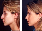 Rhinoplasty