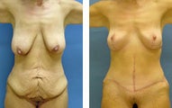 Body lift following massive weight loss