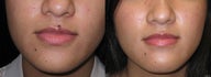 Mole removal using plastic surgery techniques