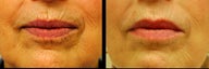 Juvederm and Belotero