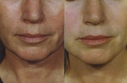 Laser Resurfacing of the face