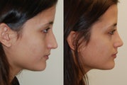 Rhinoplasty Surgery. 1 month post-op.