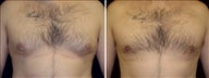 30 Year Old Man, male breast reduction