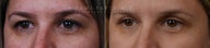 Before and After Bilateral Upper Eyelid Blepharoplasty