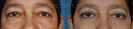 Before and After Upper and Lower Eyelid Blepharoplasty