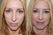 Silikon-1000 injections to cheeks and lower eyelid grooves. Botox.