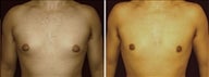 22 year old male, male breast reduction