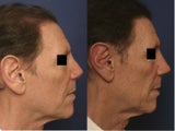Rhinoplasty Revision