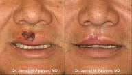 Lip Reconstruction