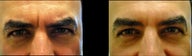Juvederm and Botox