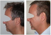 Necklift and Neck Liposuction