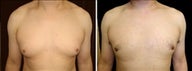 37 year old male, male breast reduction