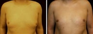 27 year old male, male breast reduction
