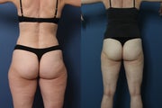 Liposuction- laser assisted (Smart Lipo) of Outer Thighs