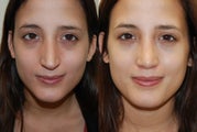 Rhinoplasty Surgery. 1 month post-op