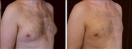39 year old male, male breast reduction