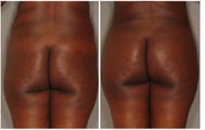 Brazilian Butt Lift 