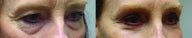 Eyelid Surgery