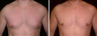 29 year old male, male breast reduction