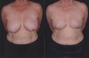 Breast Reduction