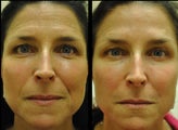 Juvederm and Radiesse