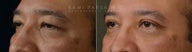 before After bilateral upper eyelid blepharoplasty