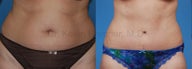 Tummy Tuck