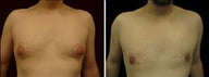 34 year old male, male breast reduction