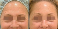 Endoscopic Brow Lift + Lower Blepharoplasty