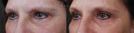 Before and After upper and lower eyelid blepharoplasty with fami endobrow and PCA