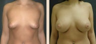 Breast Augmentation