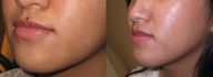 Mole Removal photos