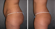Tummy Tuck