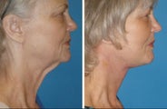 Neck lift