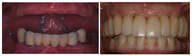 Implant Before and After