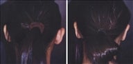 Ear Surgery