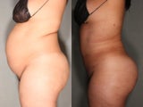 26 Year Old Female Treated For Unwanted Fat and Fat Transfer To Buttocks