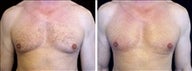 45 year old male, male breast reduction