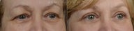 before and after bilateral upper eyelid blepharoplasty
