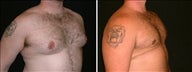 24 year old male, male breast reduction