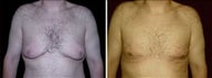 30 year old male, male breast reduction