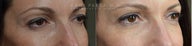 Before and After of Upper Eyelid Blepharoplasty