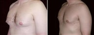 34 year old male, male breast reduction