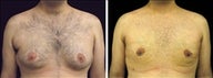 29 year old male, male breast reduction