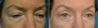 bilateral upper and lower eyelid blepharoplasty with ptosis repair
