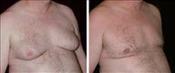 47 year old male, male breast reduction