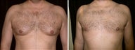 44 year old male, male breast reduction
