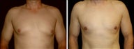 36 year old male, male breast reduction