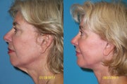 Chin implant 