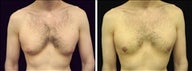 37 year old male, male breast reduction